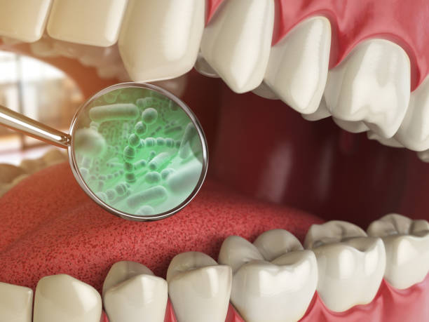 Illustration of bacteria pockets between teeth